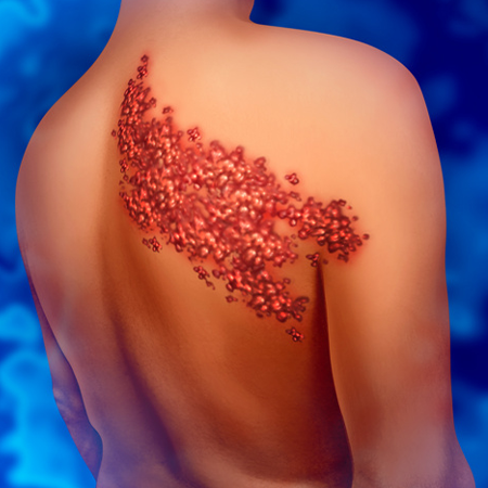 Опоясывающий лишай